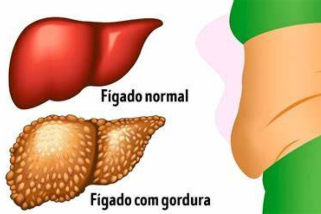 Gordura no Fígado: História Envolvente